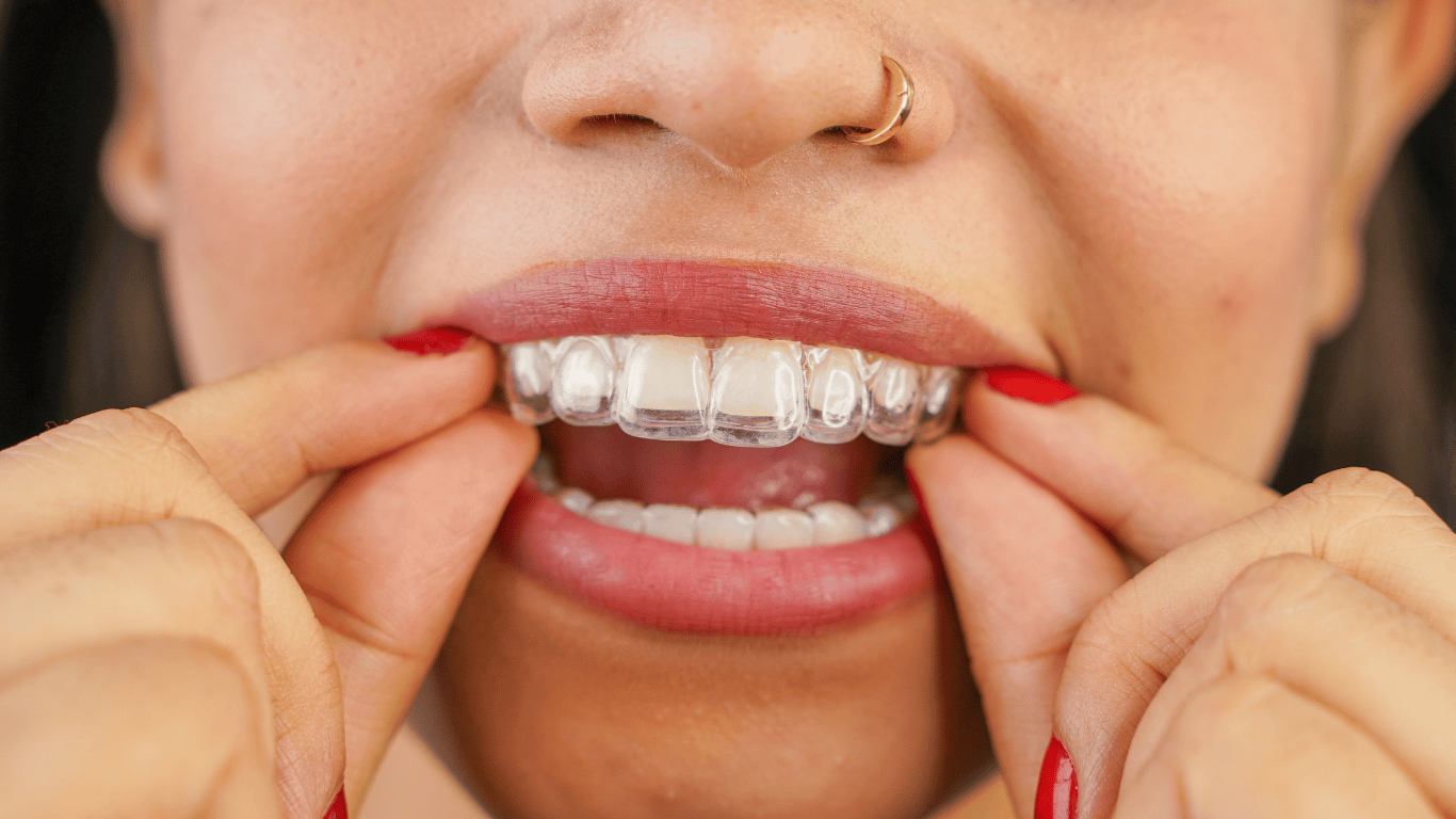 Clear Aligners 101
