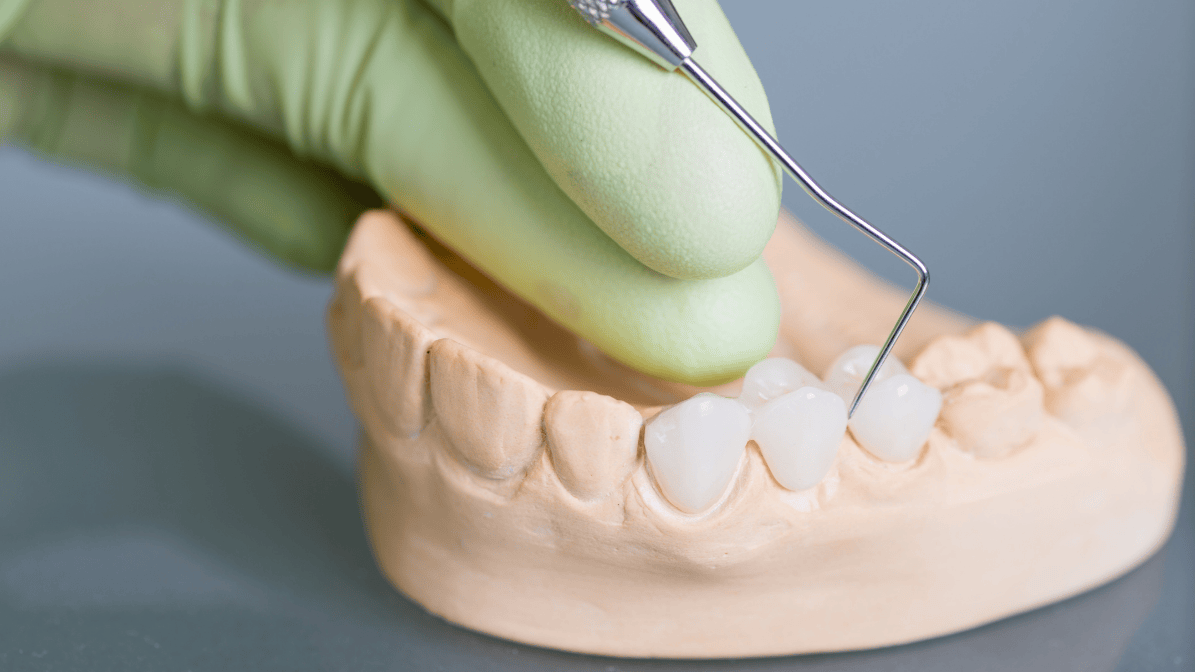 Dental bridges