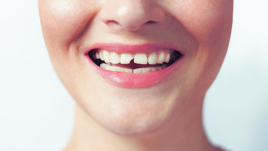 chipped tooth