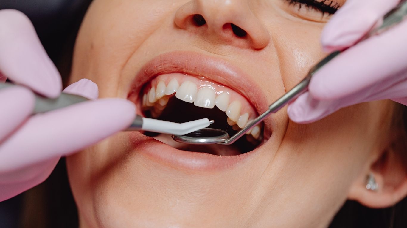 dental sealants