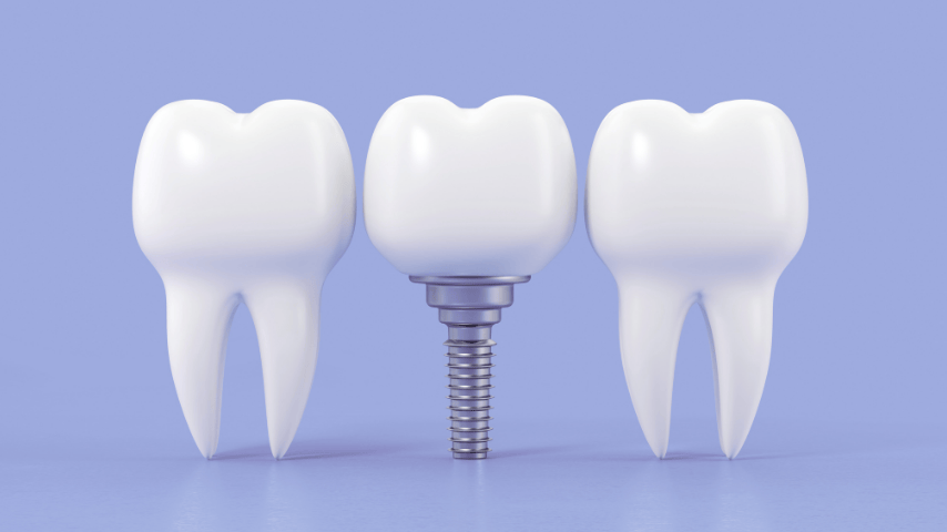 Mini dental implants
