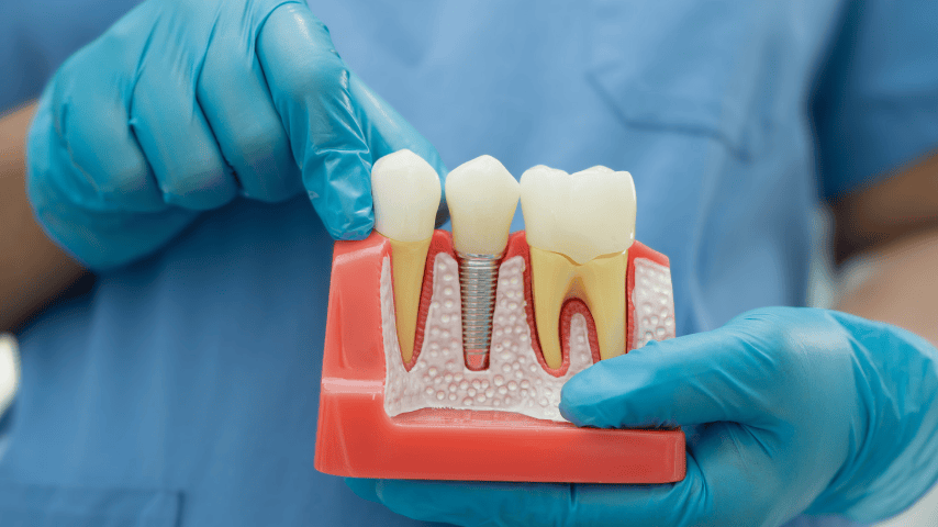 dental implant restoration