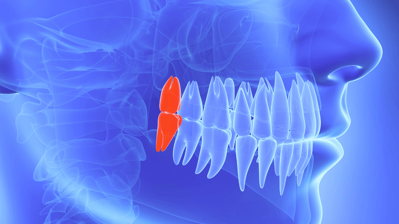 Wisdom Teeth Removal Cost What You Need to Know