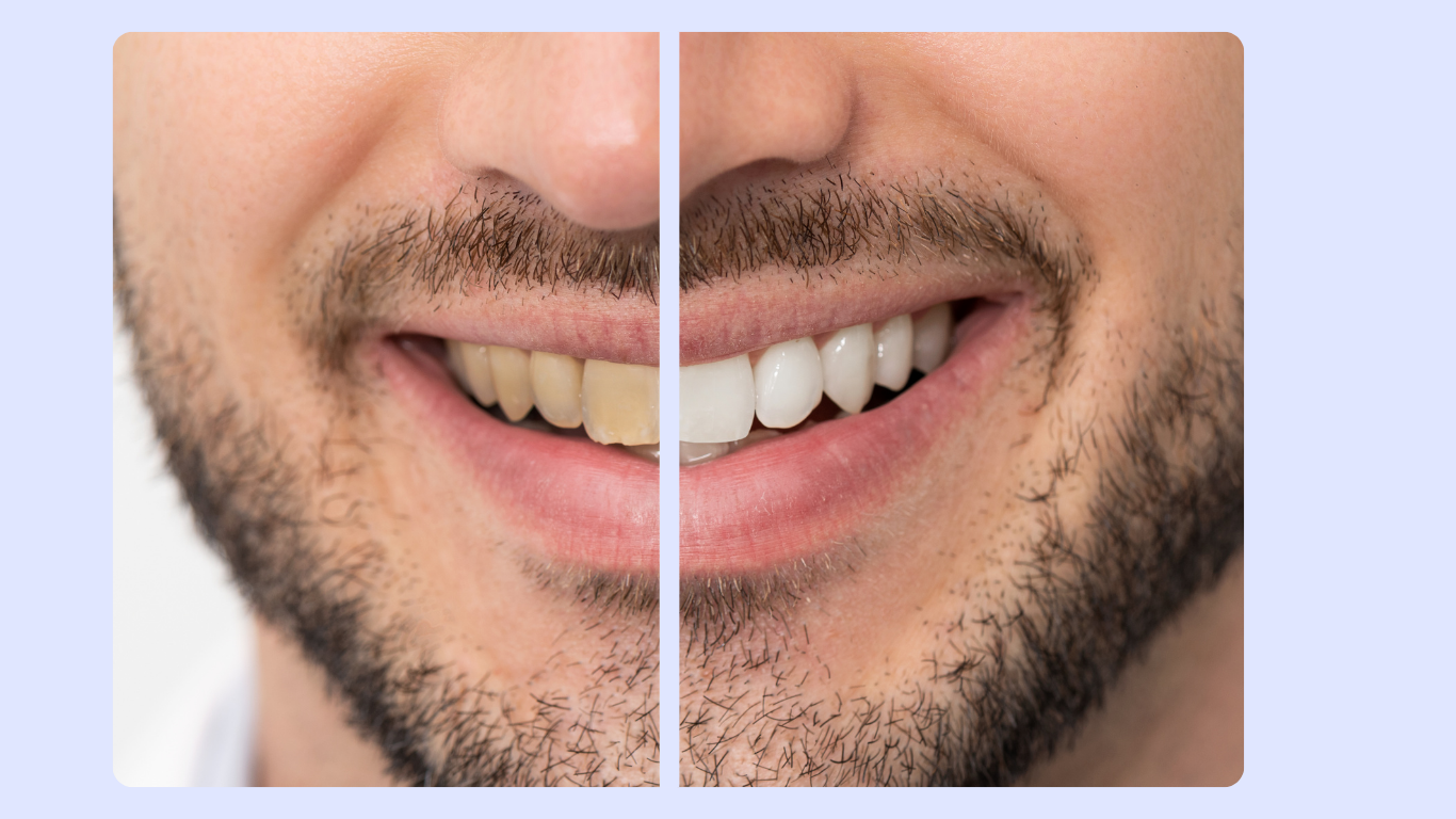 smoking yellow teeth whitening